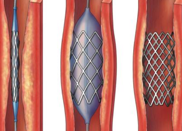好消息！700元冠脈支架來(lái)了帶量采購(gòu)結(jié)果在甘肅省正式落地執(zhí)行